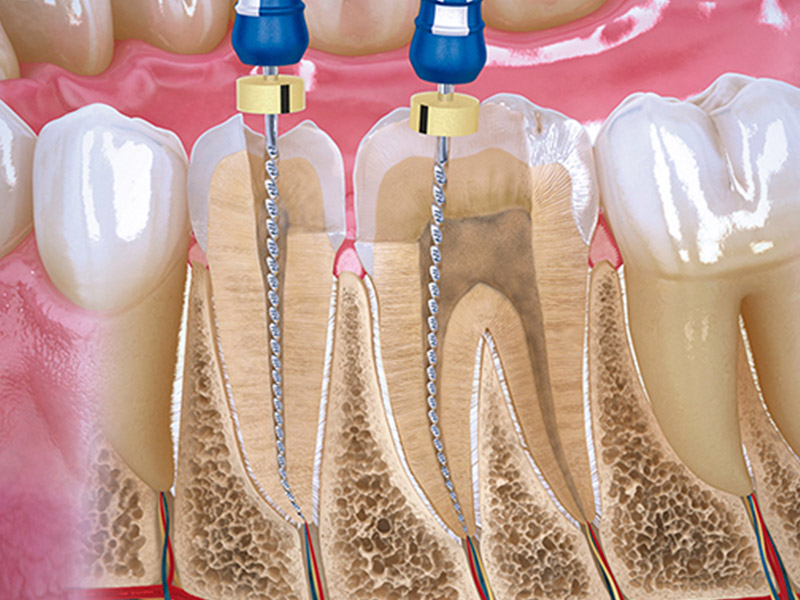 revision dental