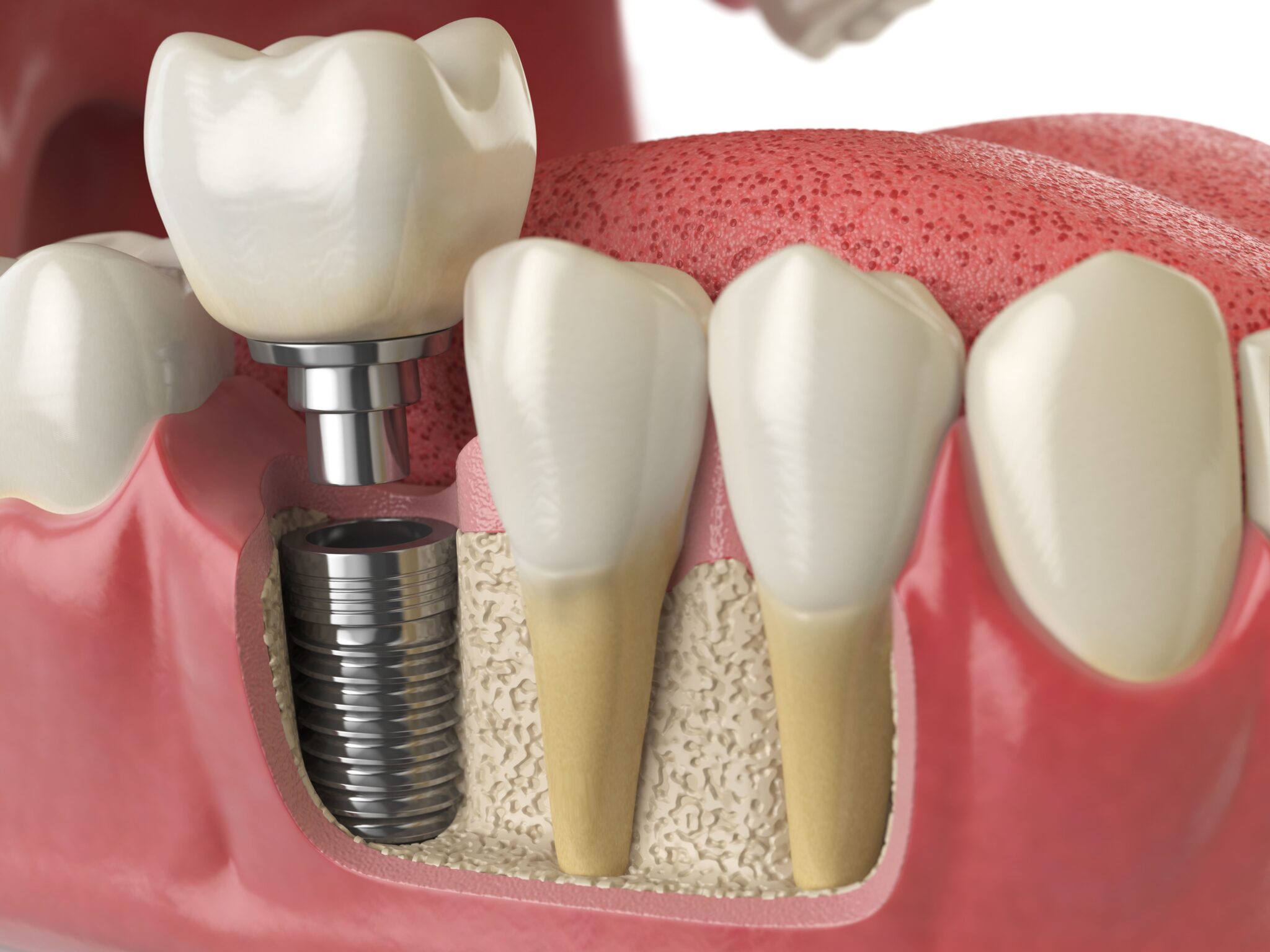 revision dental