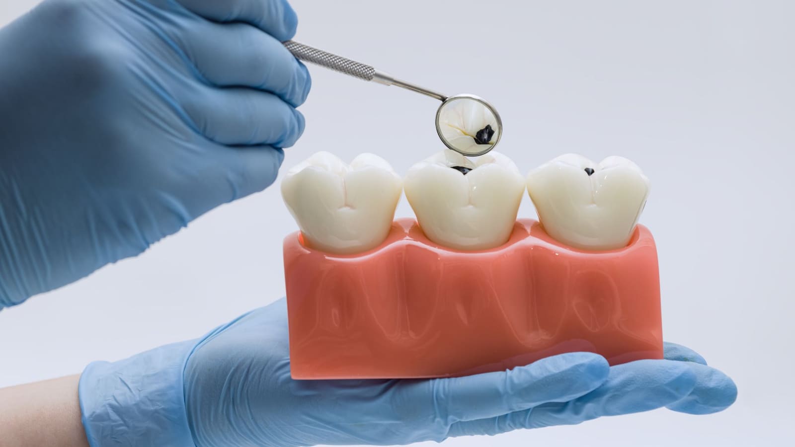 Modelo dental con caries pequeñas en las muelas revisado con un espejo de dentista