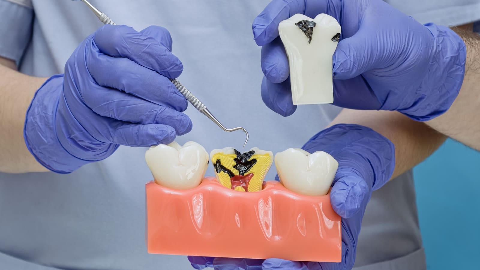 Dentista señalando en un modelo dental una caries profunda que llega hasta el nervio de la muela