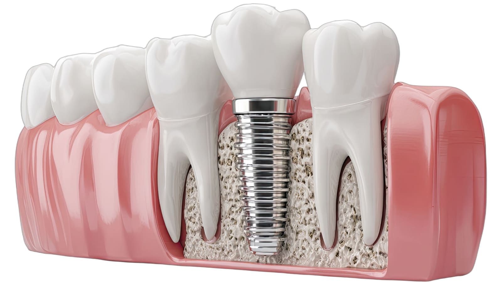 Corte de un implante dental: la raíz de titanio dentro del hueso, entre dos dientes naturales