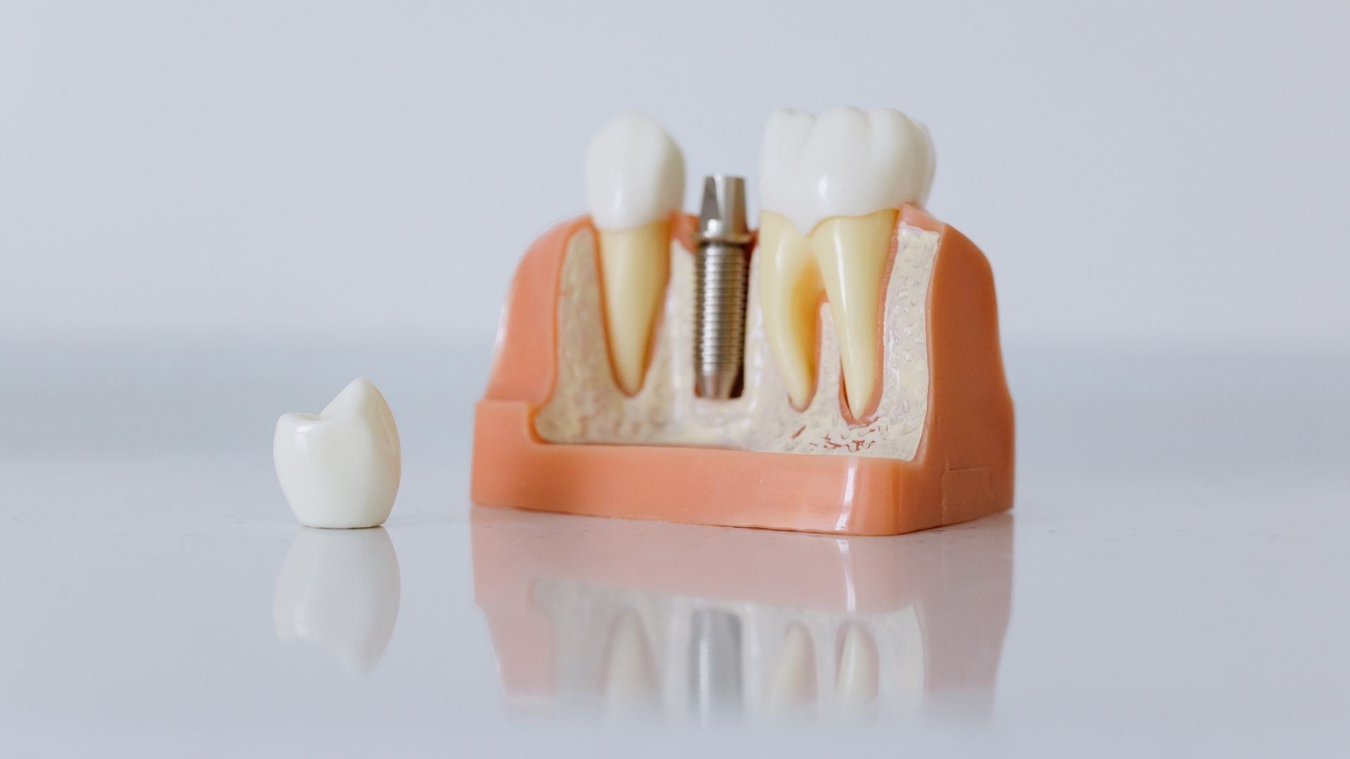 Modelo de implante dental con corona para explicar una prótesis en Peñagrande