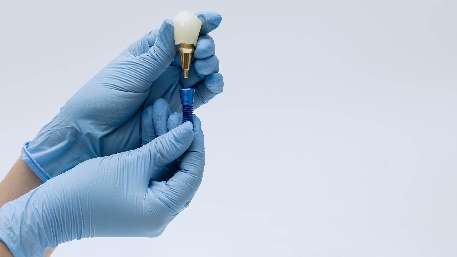 Corona dental de cerámica lista para colocarse, en la clínica de Peñagrande