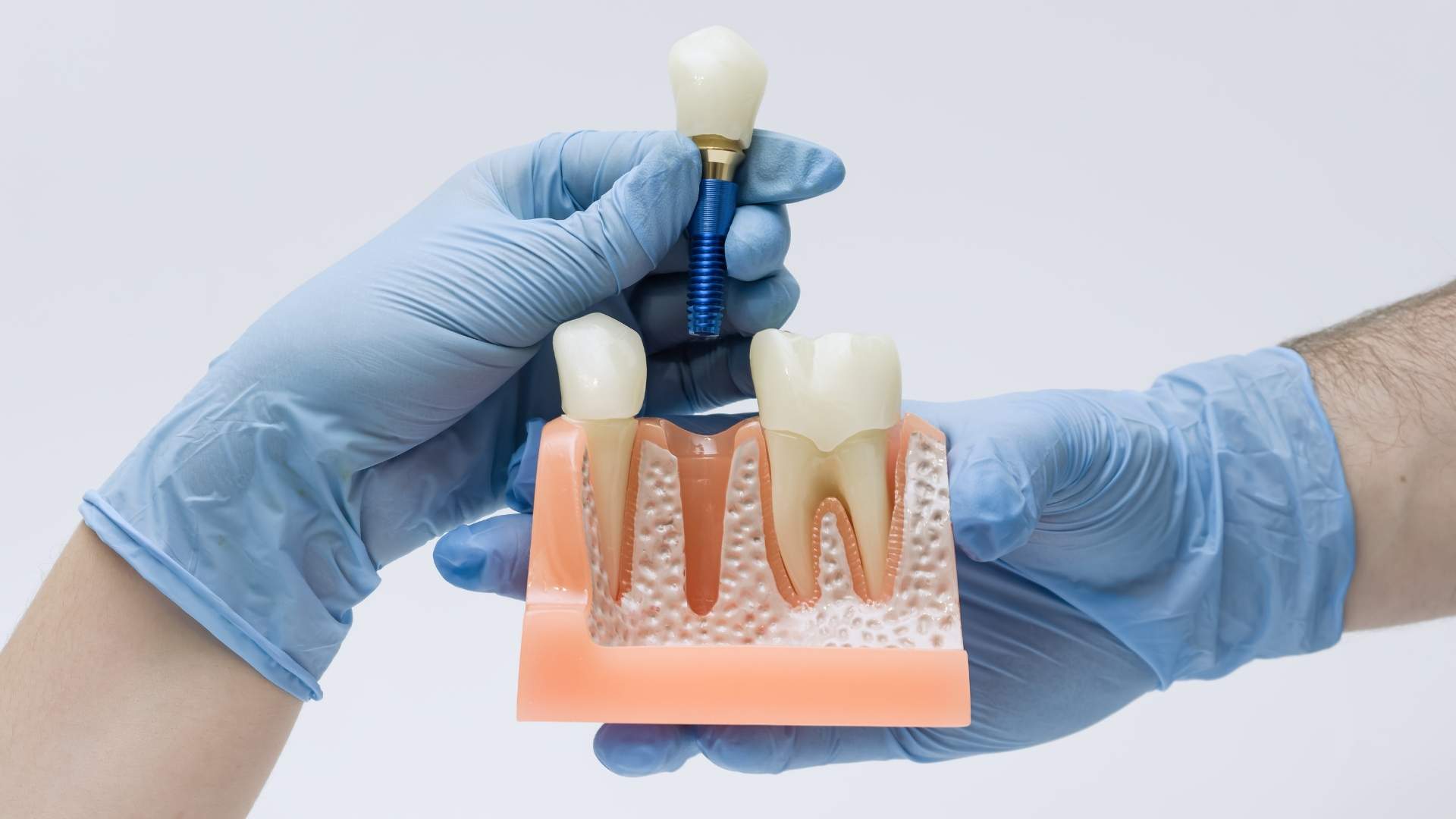 Prótesis atornillada sobre implante dental en la Clínica Dental Arosa de Peñagrande