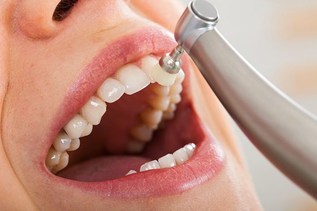 Tratamiento de gingivitis en la Clínica Dental Arosa de Peñagrande