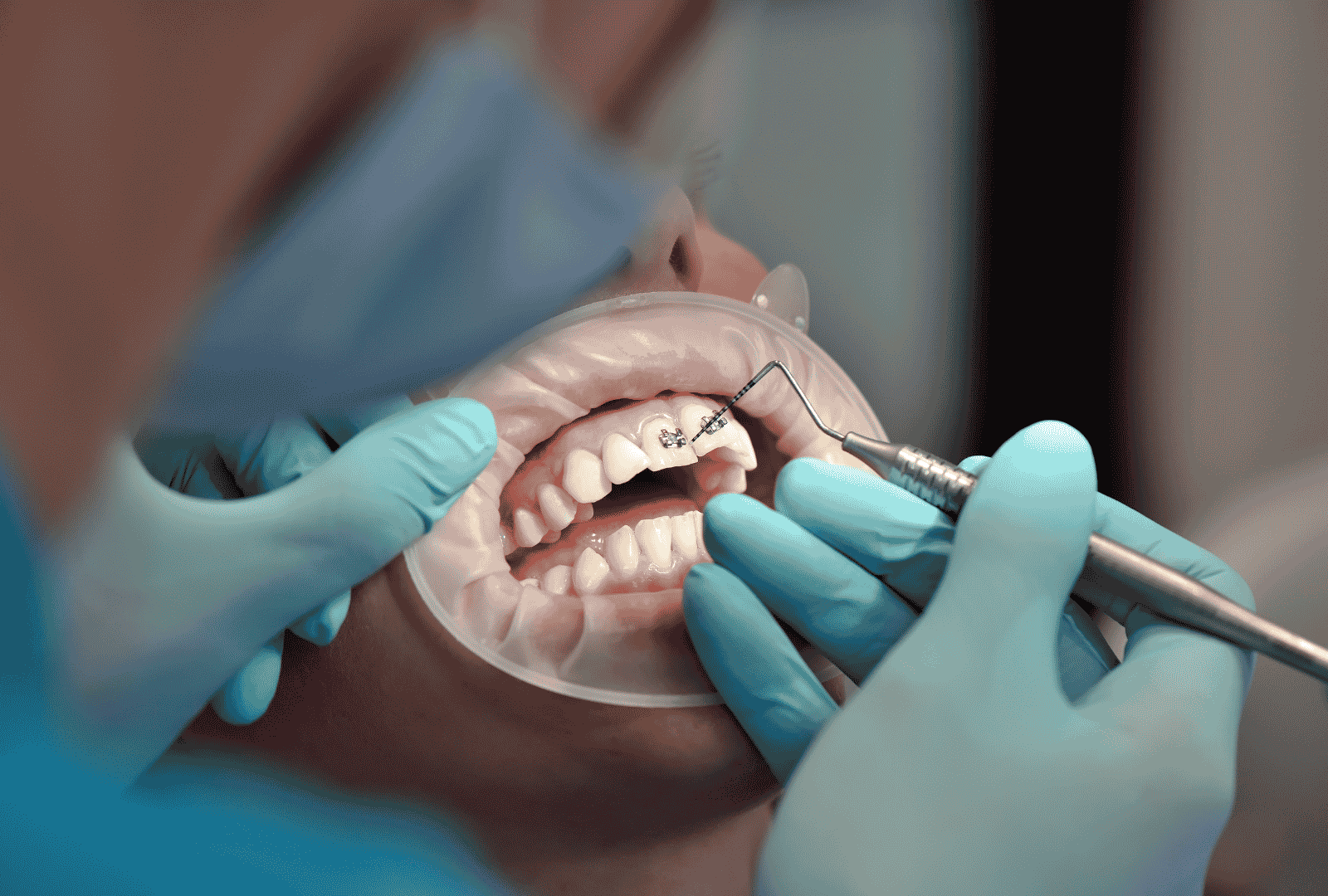 Ortodoncia en Peñagrande: detalle de un tratamiento con brackets en Clínica Dental Arosa