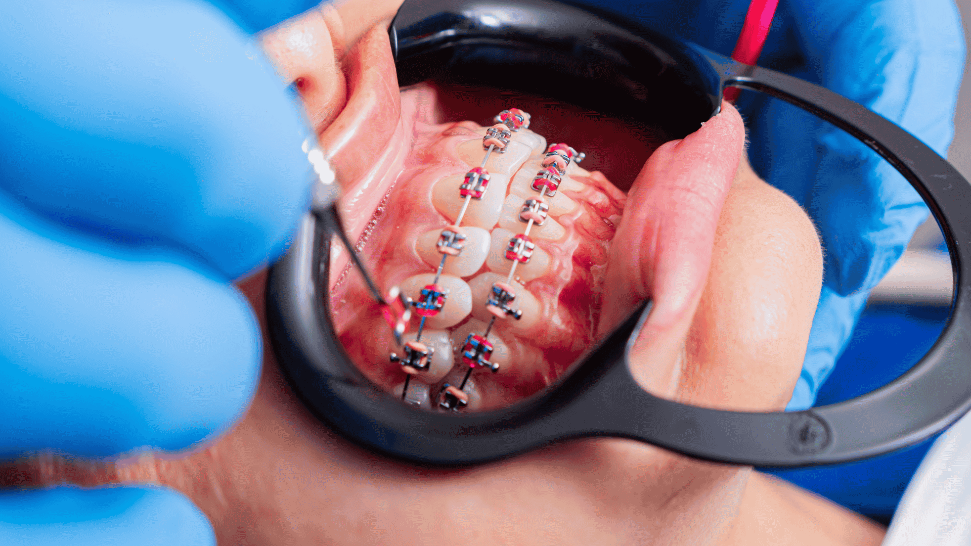 Detalle de un tratamiento de ortodoncia con brackets durante una revisión en Peñagrande