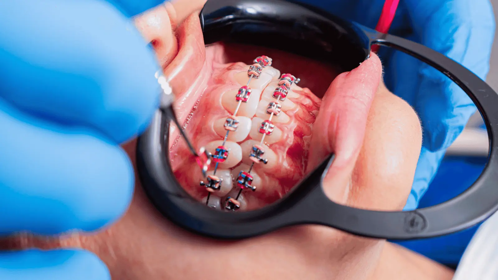 Detalle de un tratamiento de ortodoncia con brackets durante una revisión en Peñagrande